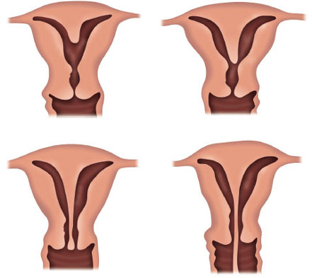 Hysteroscopic Septum Resection