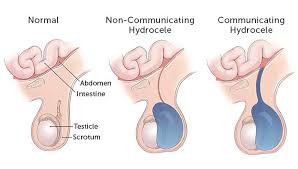 Hernia & Hydrocele Surgery