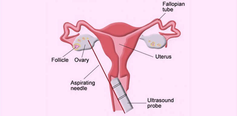 Ovulation Induction 