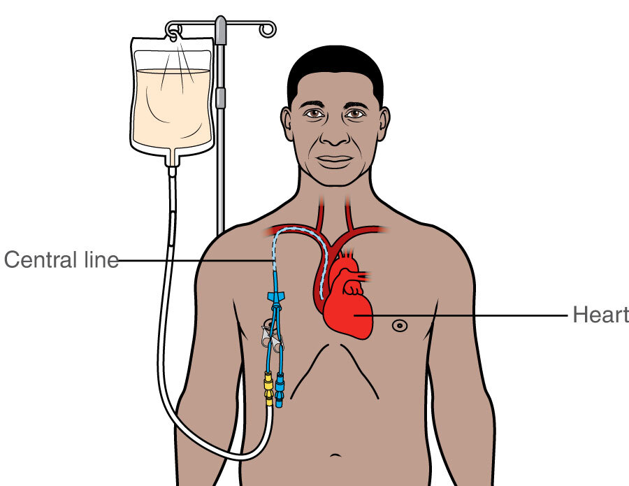 Parenteral Nutrition