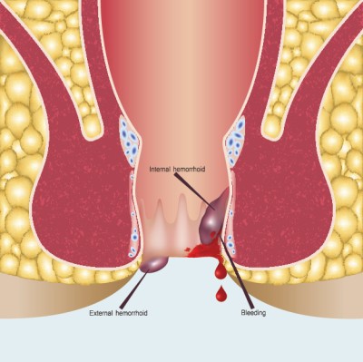 Piles Fissure Fistula Surgeries