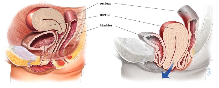 Vaginal Hysterectomy