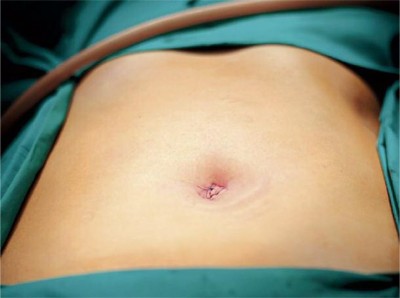 laparoscopic tubal ligation